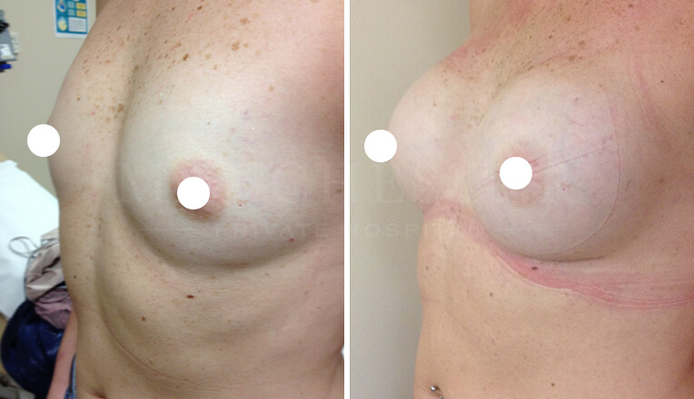 breast augmentation by ms nabila nasir-2