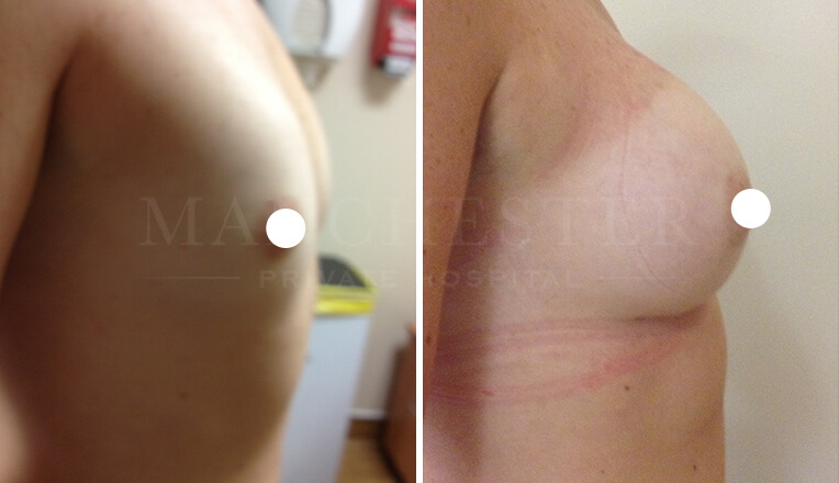 breast augmentation by ms nabila nasir-4